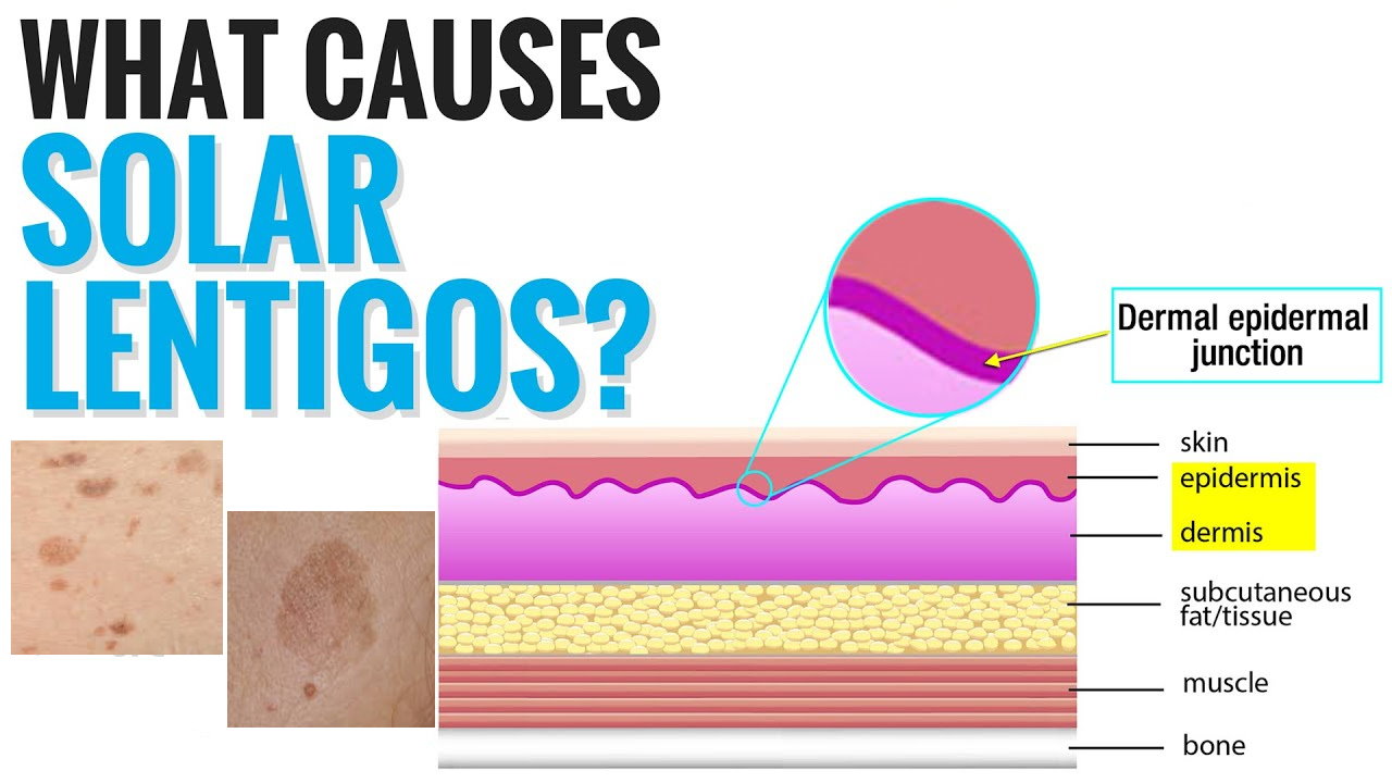 孚美达“氟轻松氢醌维A酸乳膏”能用于老年斑治疗吗？