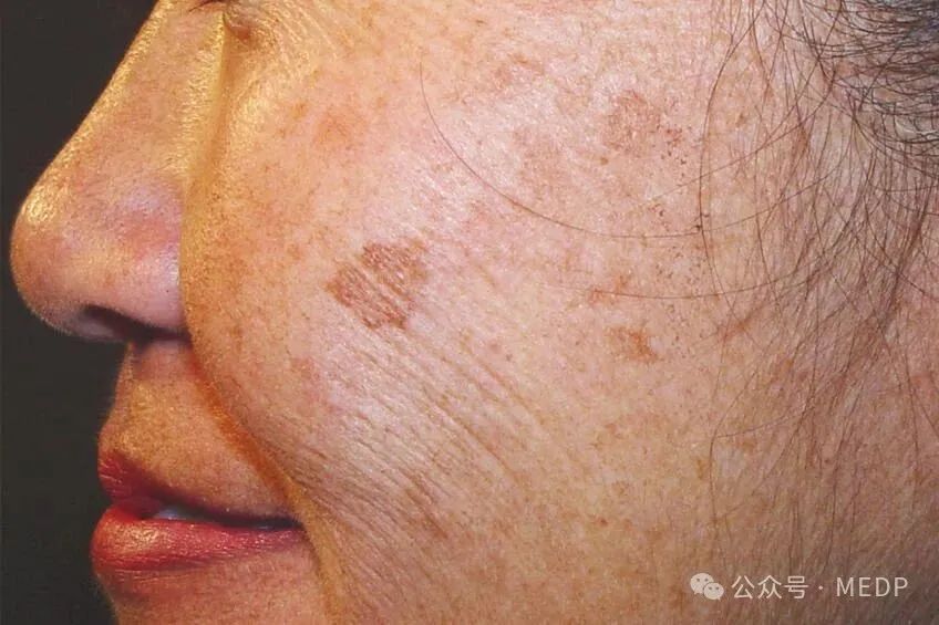 老年斑、晒斑、日光性雀斑是一回事吗？